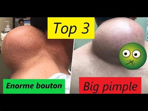 pornhub gros|Compilation : Gros bouton / Big pimple 2020 .